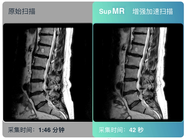 深智透医AI医学影像增强产品SupMR、SupPET获欧盟新规首证